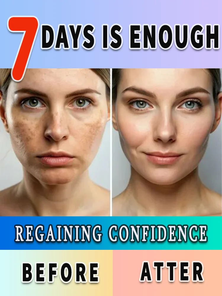 Remove freckles and whiten the skin, lighten and brighten facial dark spots