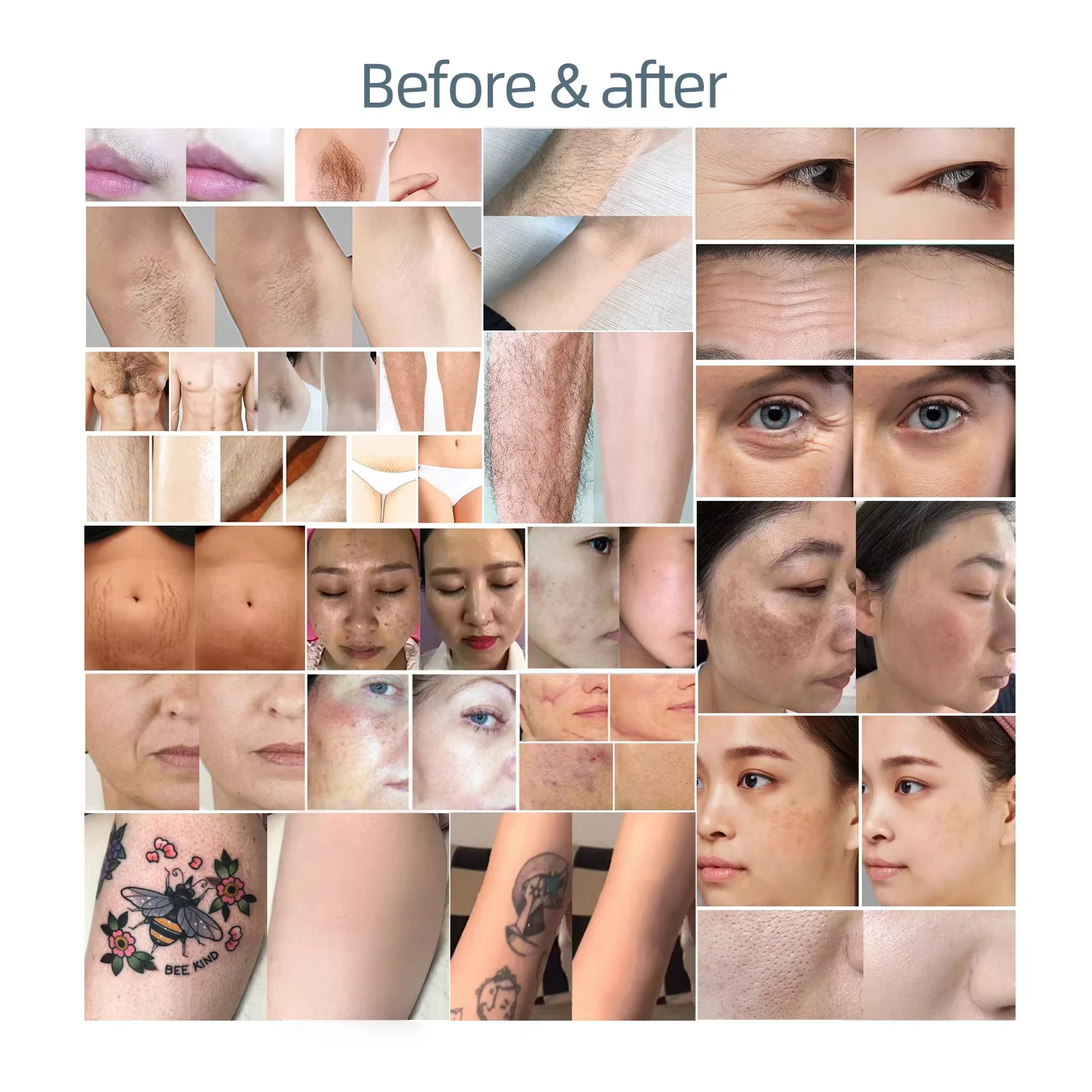 

Устройство 2025 Сопрано Титан 808 Диодный лазерный аппарат для удаления волос 3 длины волны Безболезненное лазерное устройство для волос 4000 Вт