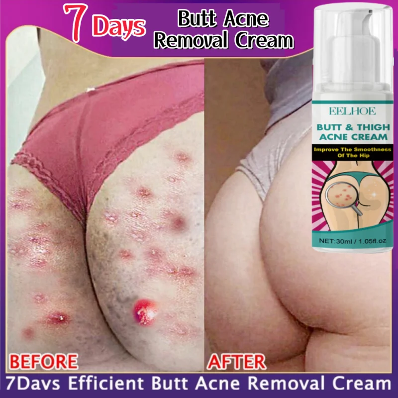 Effective Acne Treatment Cream Remove Acne Mark On Buttock Thigh Back Clear Face Dark Spot Pimples Zit Pore Clogging Body Lotion