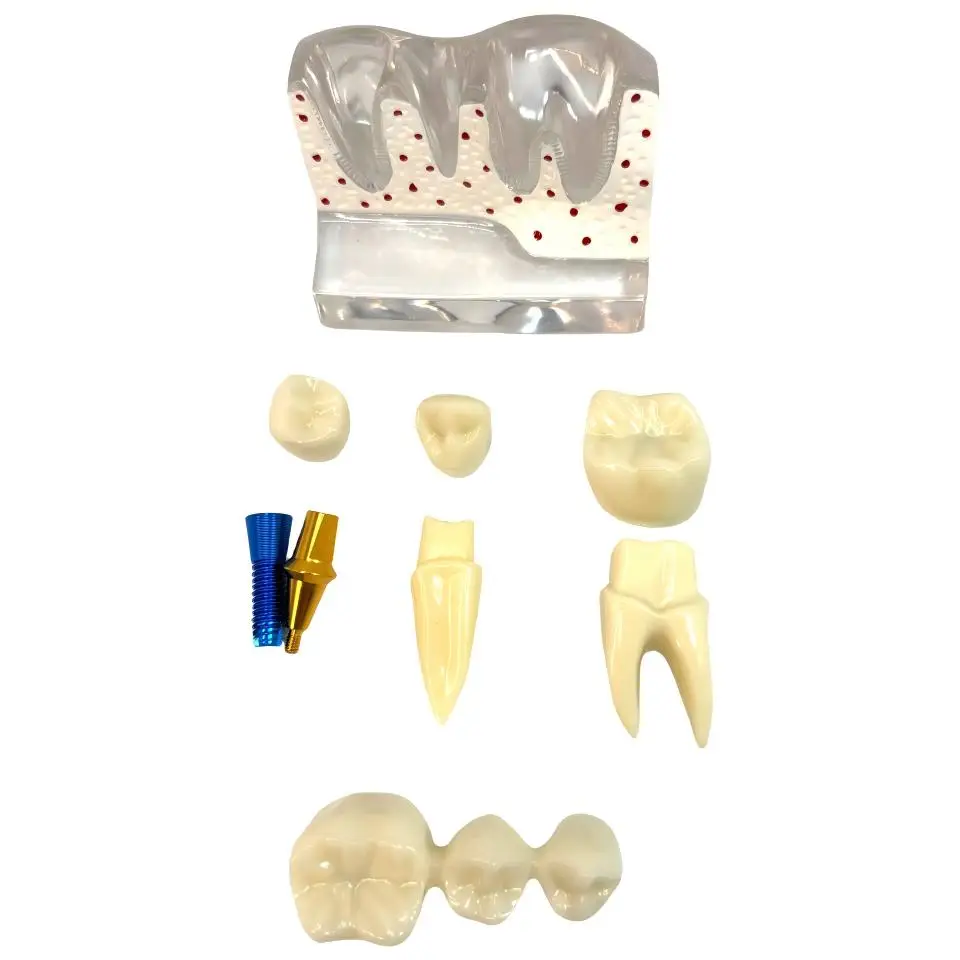 Dental Implant Pathology Demonstration Model Transparent Base Detachable Crown Bridge Abutment for Patient EducationConsultation