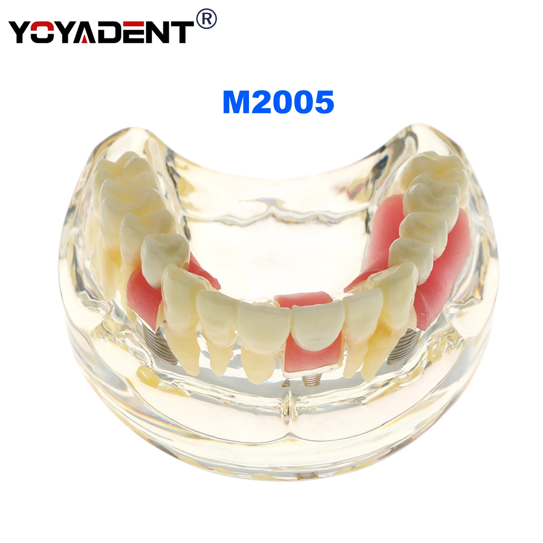 

Dental Teeth Model with implant supported bridge Demonstrates plaque caries abscessfor Teaching Demo Model