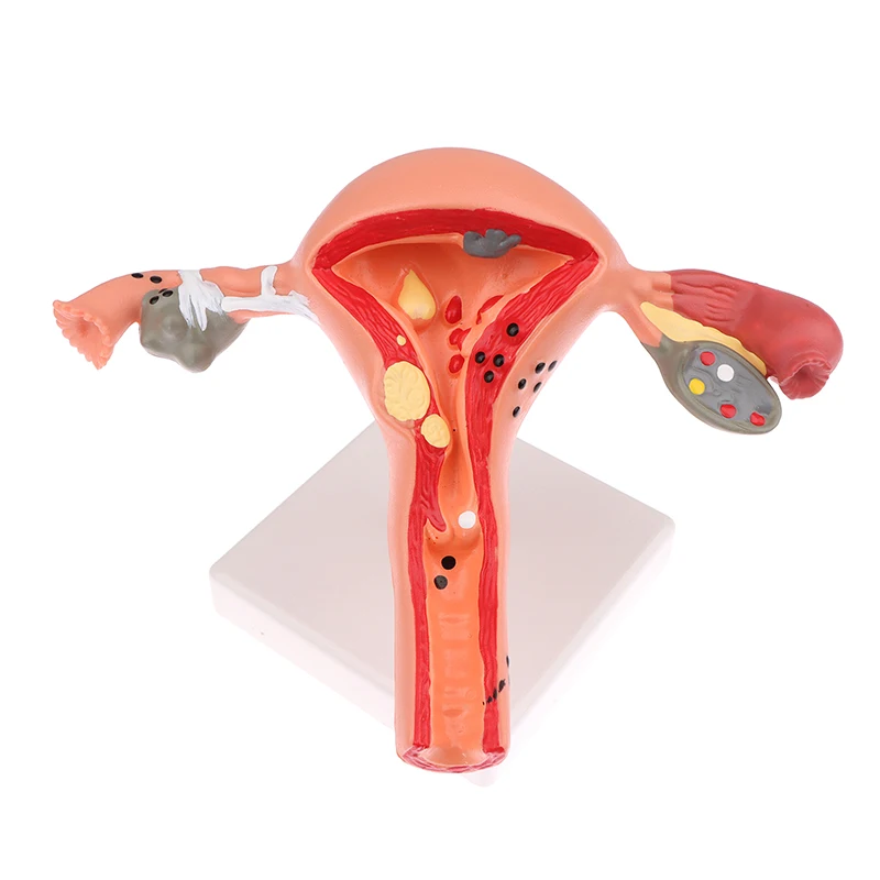 1Pcs Medical Props Model Pathological Uterus Ovary Anatomical Model Anatomy Cross Section Study Tool