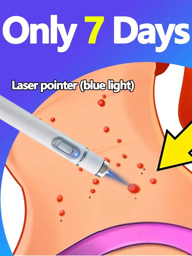 Sell Like Hot Cakes Generation-2 Laser Says Goodbye To all warts In 7 Days