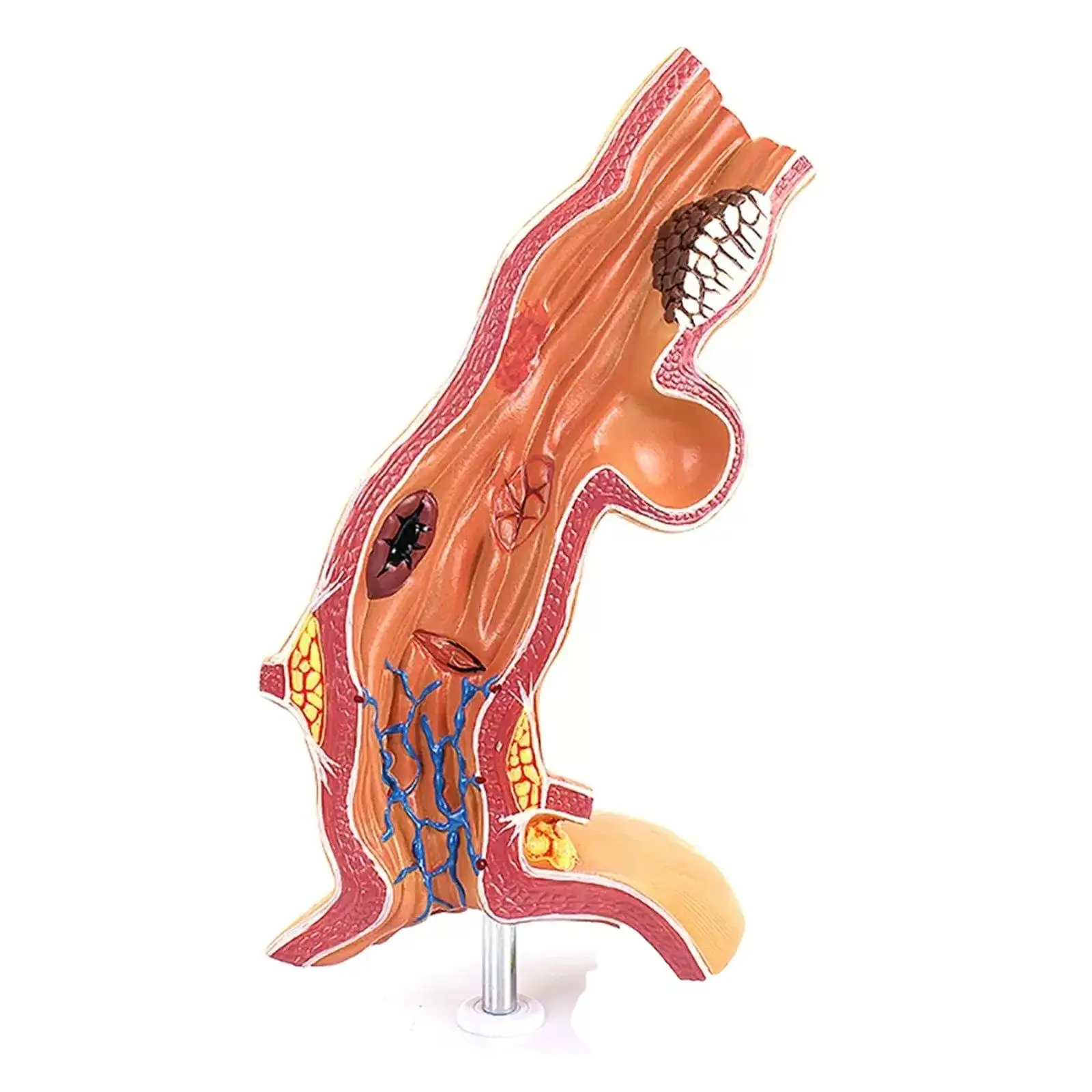 

Human Pathology Of The Esophagus Esophageal Cancer Model Medical School