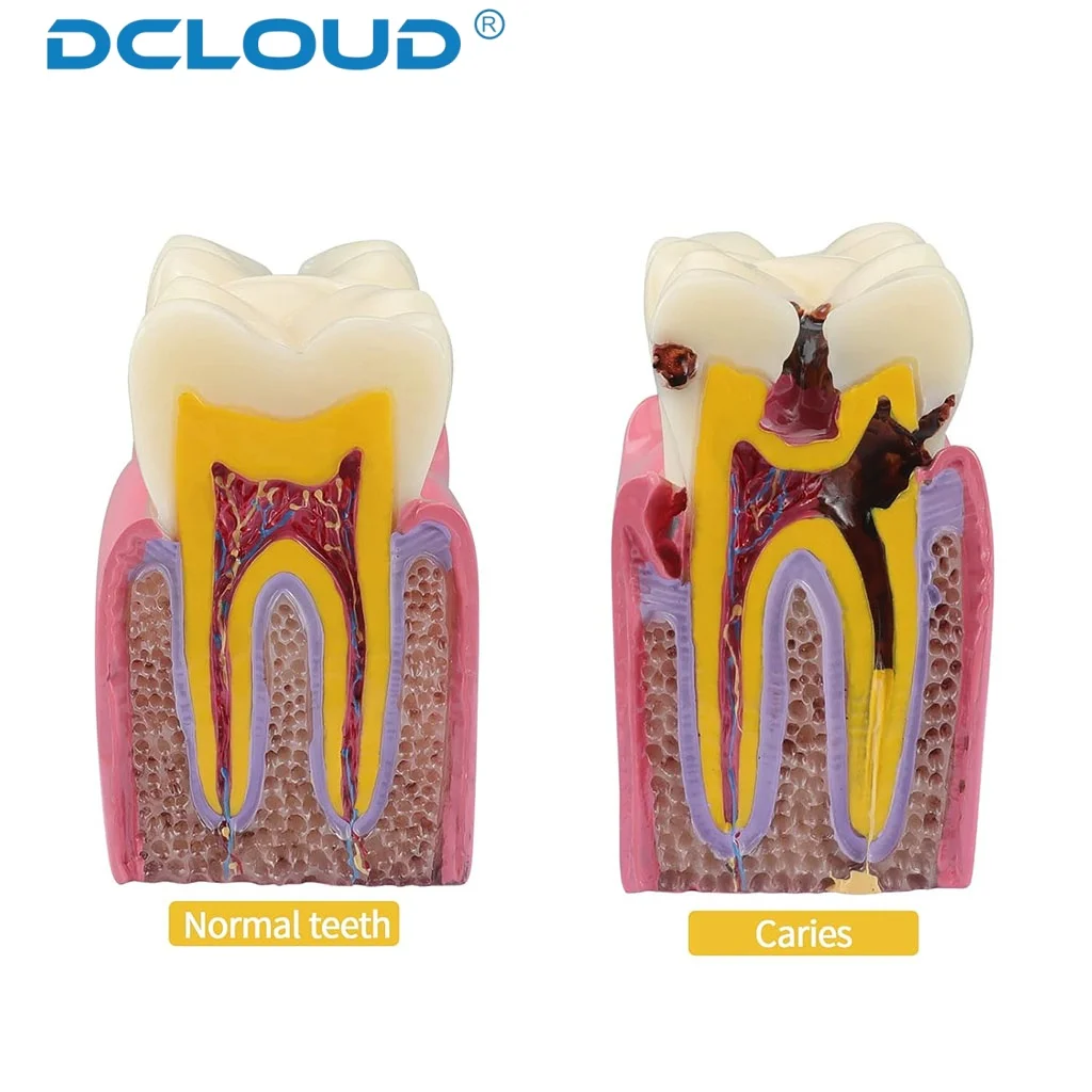 6 Times Study Models Dental Caries Comparsion Teeth Models for Dentist Studying Teaching Anatomy Practice Dentistry Tooth Model