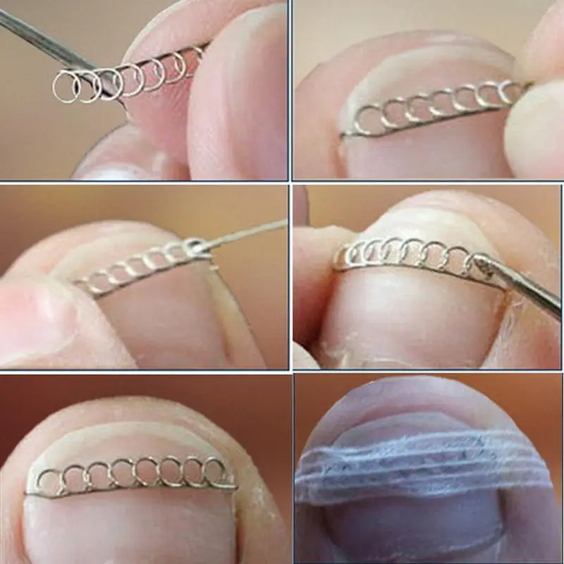 12 Stück / Box Eingewachsener Zehennagel-Korrektor Federdraht-Fixierer Pediküre-Nachrichtungsclip Patch Zehennägel Orthopädische Fußpflege – Detail 6