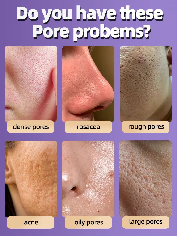 Solve the problem of enlarged pores