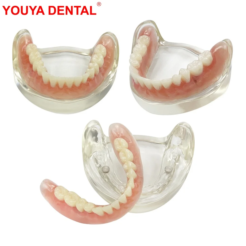 New Dental Teeth Model With Implant Overdenture Lower Jaw Dentistry Mandibular Model For Dentist Student Learning Education Demo