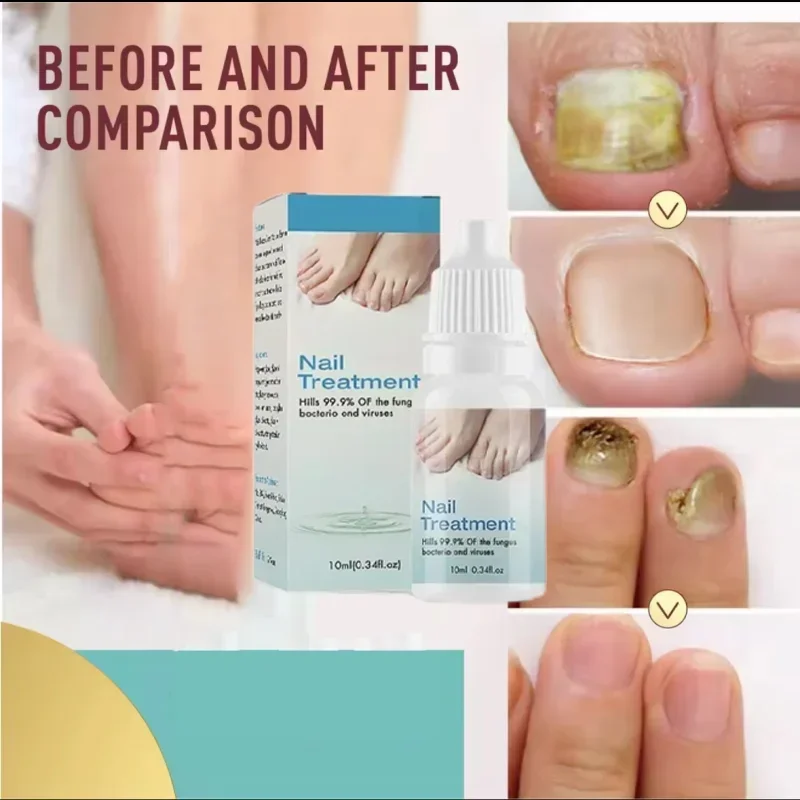 Fungal Nail Removal 10ML Fungal Nail Oil Foot Repair Essence Toe Nail Fungus Removal Gel Anti Infection Cream