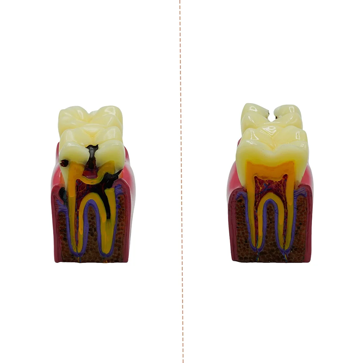 

1pcs Dental Teeth model 6 Times Caries Study Denture Tooth Models Dentist Studying Researching 6 Times Dental Caries Comparison