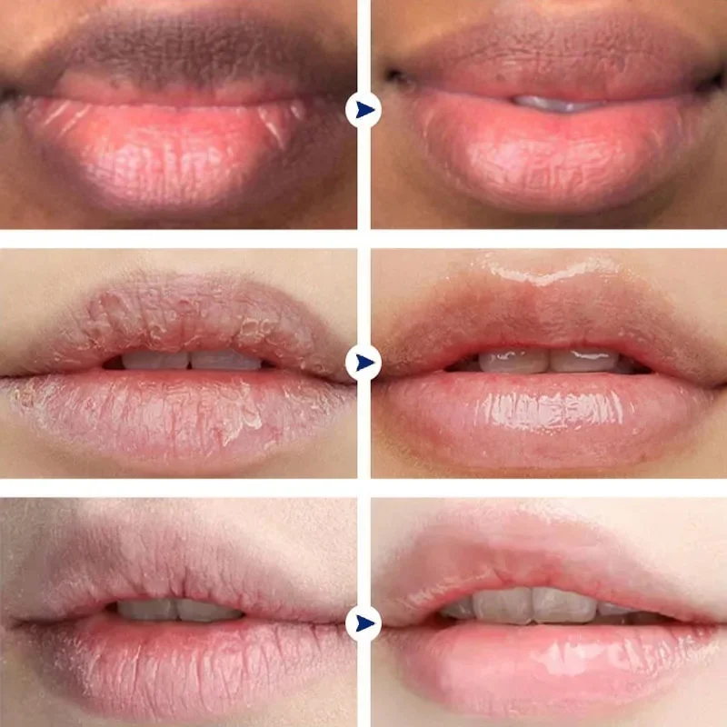 Lippenbalsem Verwijderen Donkere Vlekken Pigment Snel Lichter Roze Lippen Crème Hyaluronzuur Lippen Exfoliëren Dode Huid Witter Vochtinbrengende Verzorging