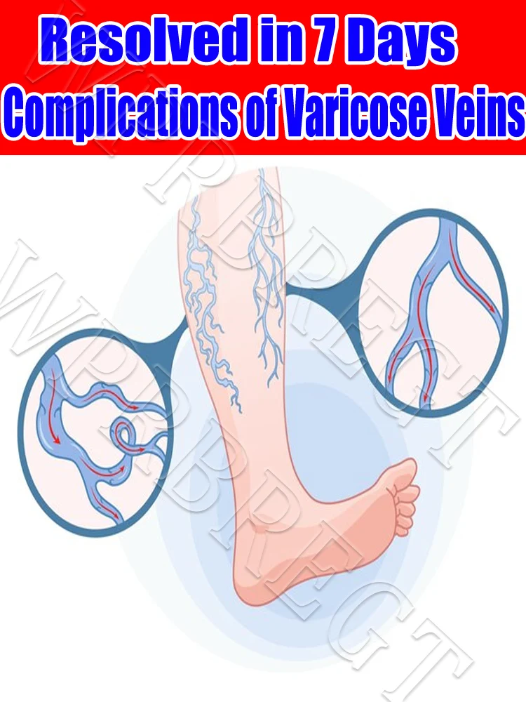

Varicose vein laser treatment pen, relieves varicose vein fatigue, fundamental treatment and no recurrence
