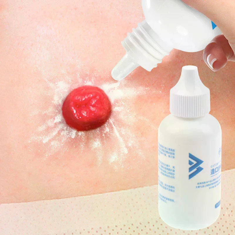 25g Skin Care Flour Dry Flour Stoma Treatment Medical For Tool Ostomy Accessory Colostomy Bag Supply Protective Care Products