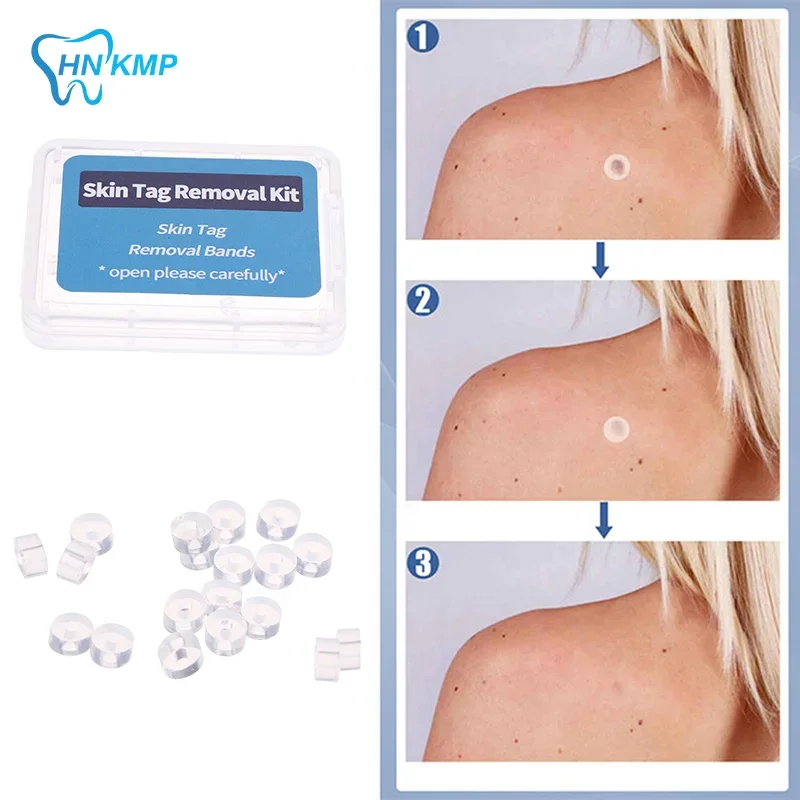 2mm-4mm Remove Skin Tag Shrink Rubber Ring 20pcs/box Non Toxic Health Beauty Skin Care Tools Tag Removal Mole Wart Removal 3
