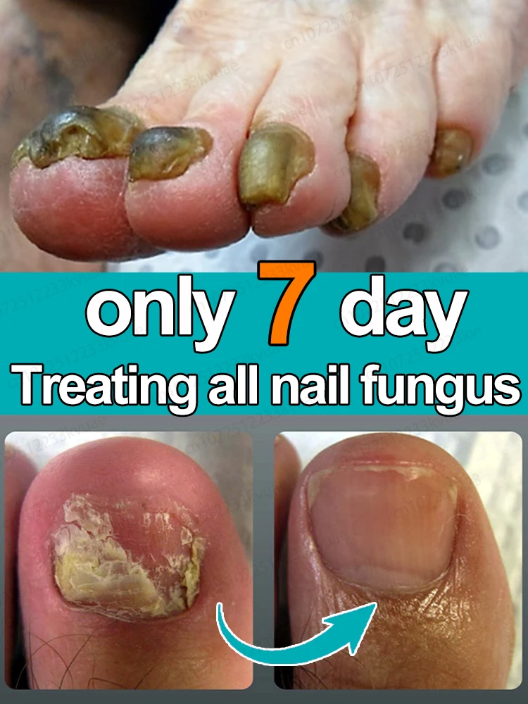 Nagelpilz-Öl. Beseitigt verschiedene Nagelprobleme und repariert Nägel.