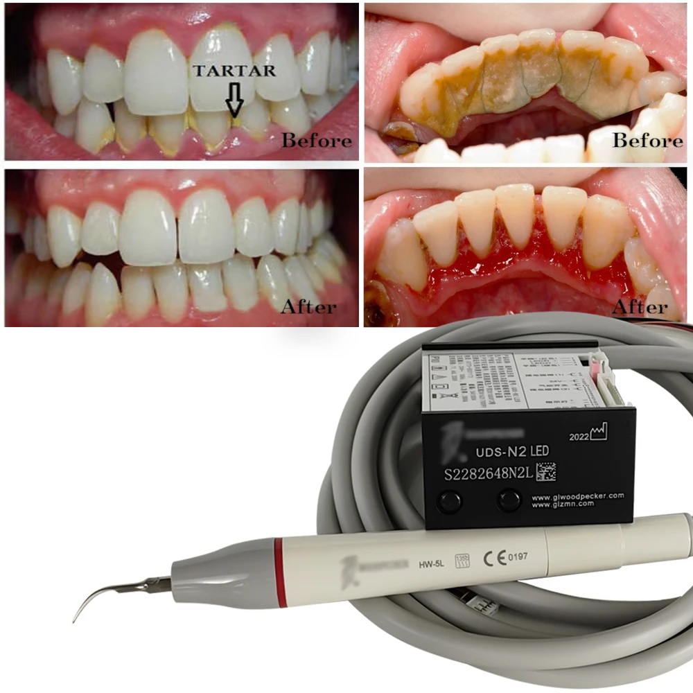 

Woodpecker Dental Scaler Ultrasonic Build In N2 LED Scaler Piezo Scaling Tips For Dental Unit Teeth Cleaning Whitening