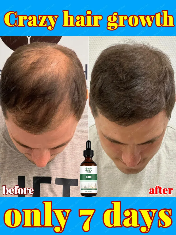 Hair Growth 𝘌𝘴𝘴𝘦𝘯𝘵 0il. Say goodbye to Mediterranean hair. The secret to thick hair, hair growth 0il