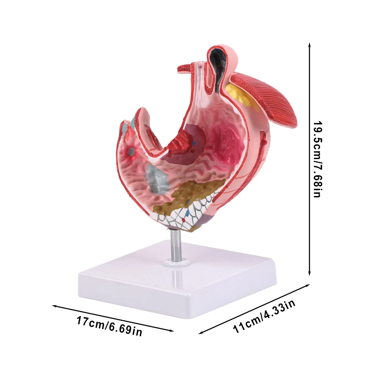 Pathological Stomach Model Human Digestive System Anatomy Coronal Section Anatomy Pathological Stomach Model