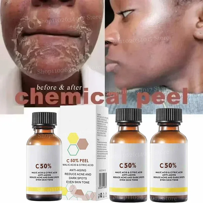 

Salicylic Acid Facial Peel Neutraliser: Unlock Profound Exfoliation at Home