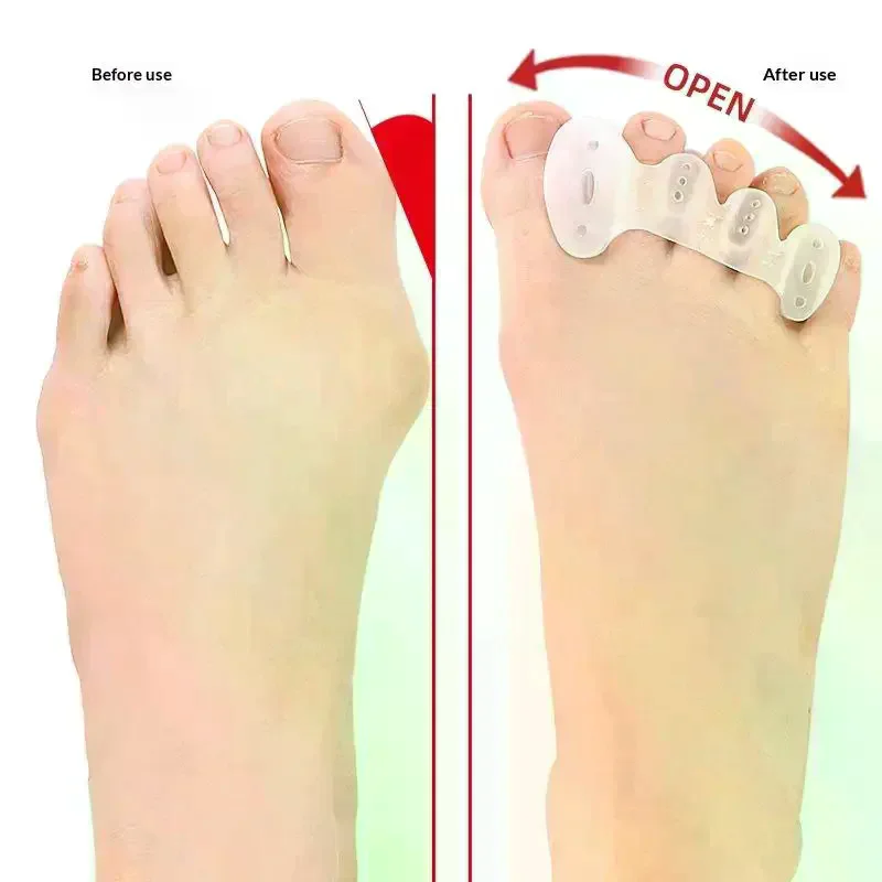 1Pair Toe Separators With Holes Correct Foot And Bunion Pain Plantar Fasciitis Toe Straightener To Improve Functional Mobility