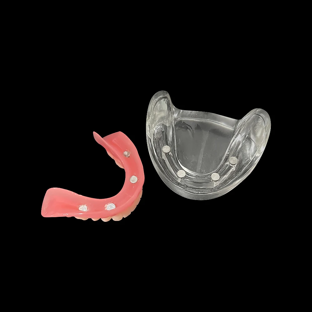 Dental Implant Model With Removable Bridge 4 Implants Overdenture Inferior Demo Mandibular Teeth Model Dentistry Clinic Products