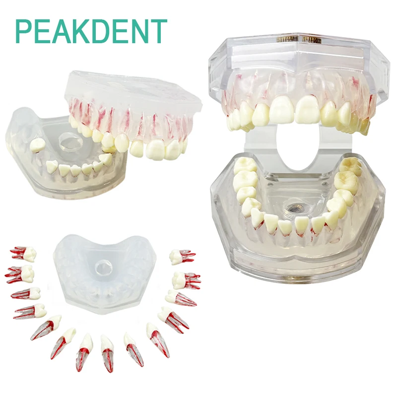 

1pcs Dental Removable Tooth Model Transparent Implant Root Canal Dental Restoration Model Dentistry Training Simulation Teaching