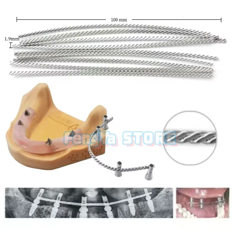 10/20/30 Pcs Dental Implant Connector Stainless Wire for Overdenture MU Impant Wire can be Welded or Bonded MU Wire Strengthener