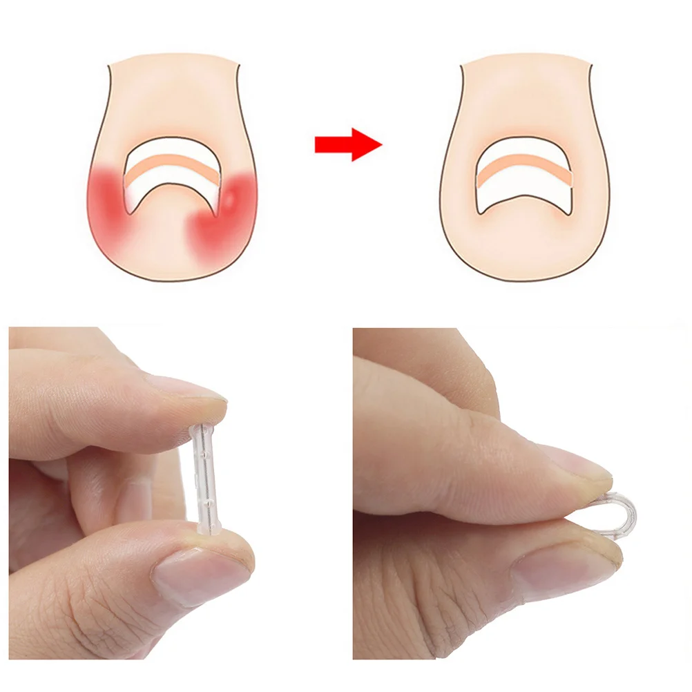 

10Pcs Silicone Titanium Alloy Toenail Correction Wire Reusable Durable Ingrown Toenail Treatment Professional Nail Care Tool