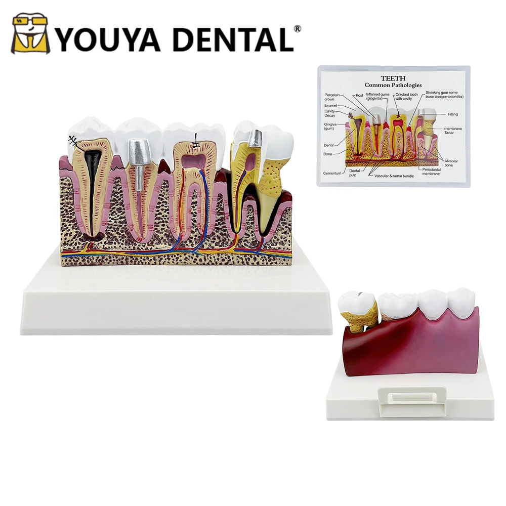 Tooth Structure Dental Model Comprehensive Anatomical Model for Dental Technician Student Studying Teaching Practice Studying