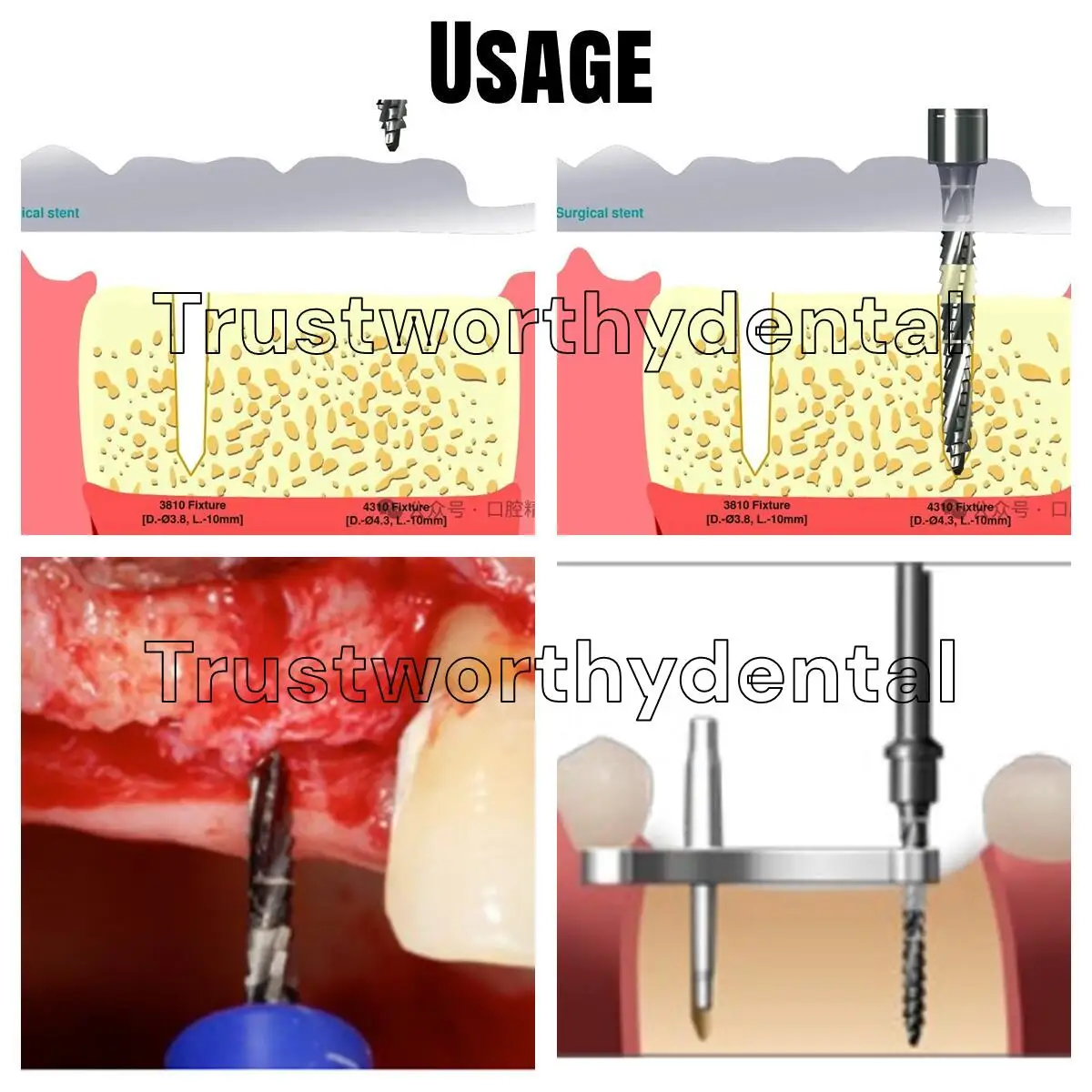 Dental Cross Cutter Drill 1mplant Pioneer Bone Side Cut Blade Fit Lindemann φ2.0