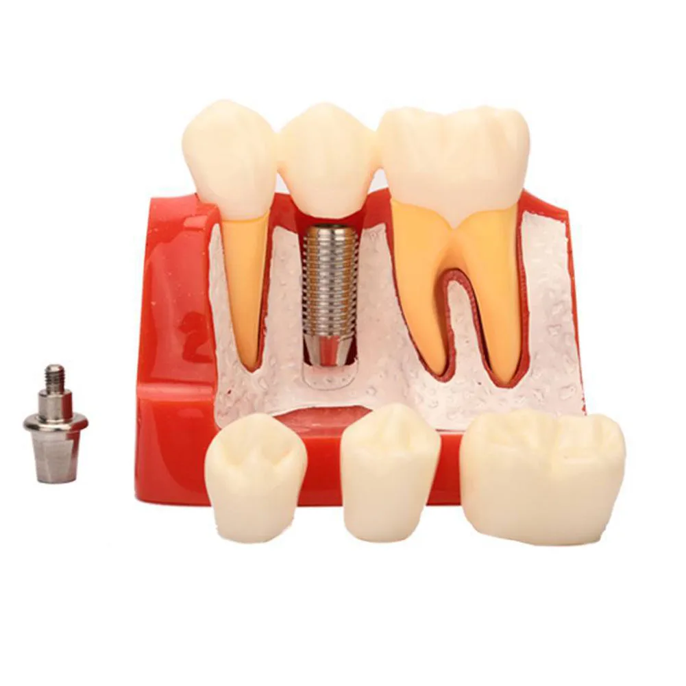 4 Times Dental Teaching Model Implant Analysis Crown Bridge Demonstration Denture Mold Set Dentist Removable Resin False Teeth