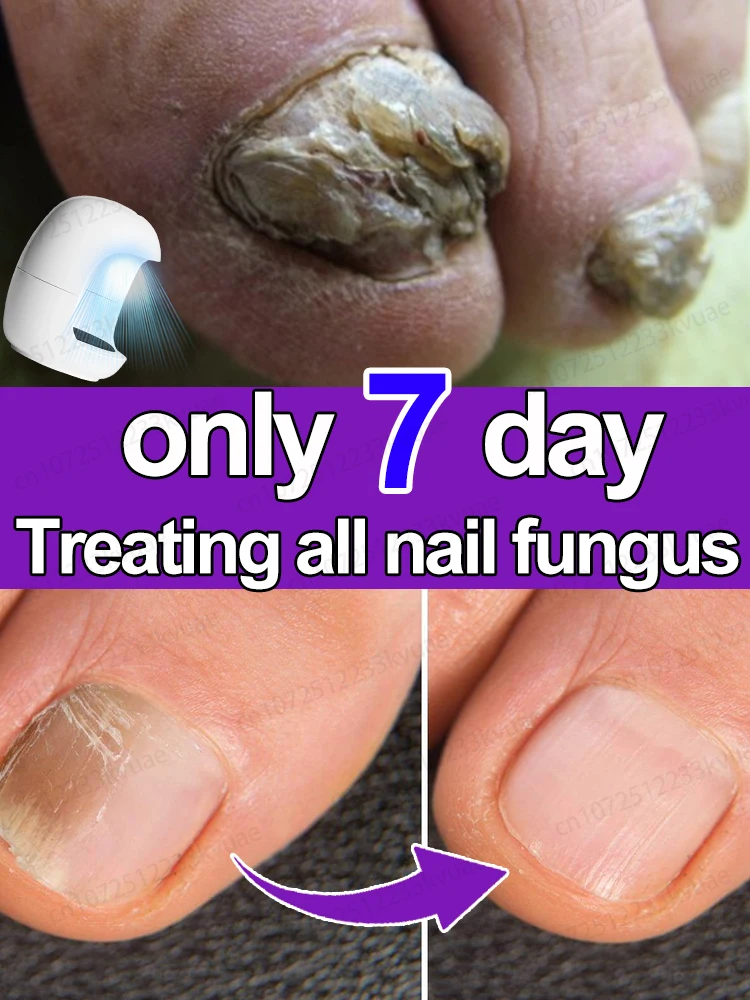 

Лазерный продукт для решения проблем с ногтями