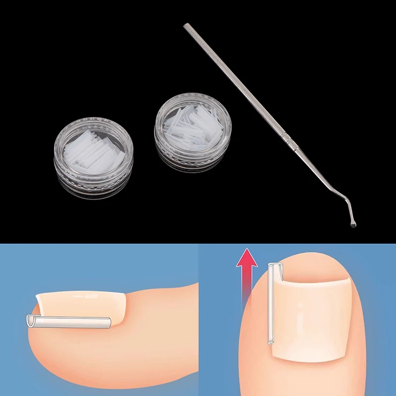 50Pcs Toenail Straightening Clip Ingrown Toenail Correction Tool Nail Treatment Elastic Patch Sticker Foot Care Pedicure