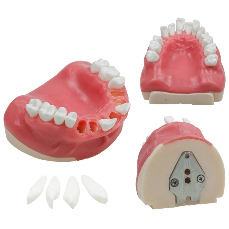 Dental Maxillary Missing Resin Bionic Model Teeth Model Training Study Model Dental Instrument