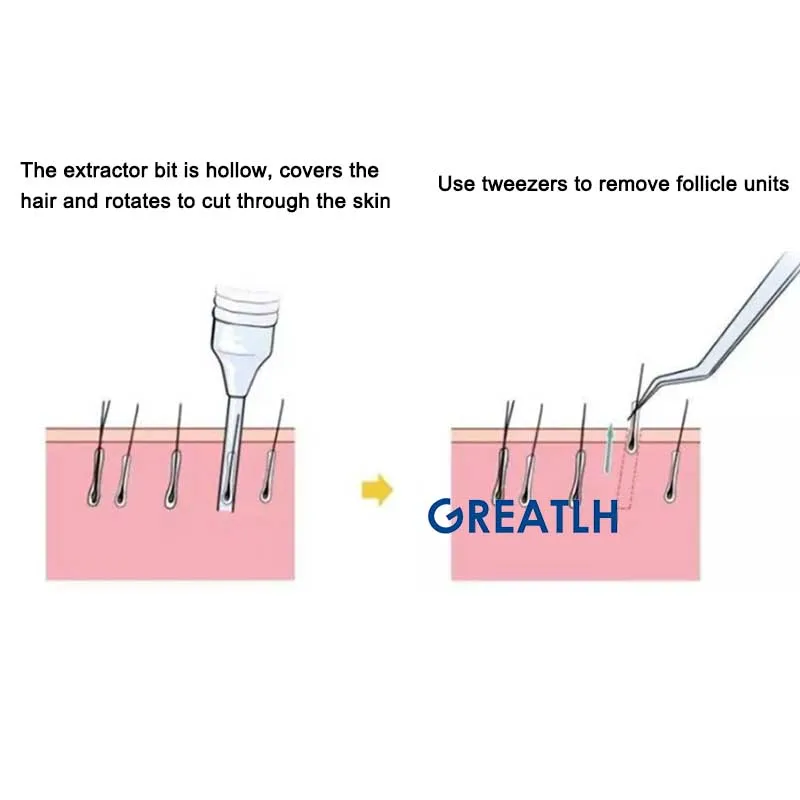 Hair Transplant Implanter FUE Punch Implanting Tools 0.8 MM 0.9MM 1.0MM for Hair Follicle Extraction Machine Stainless Steel