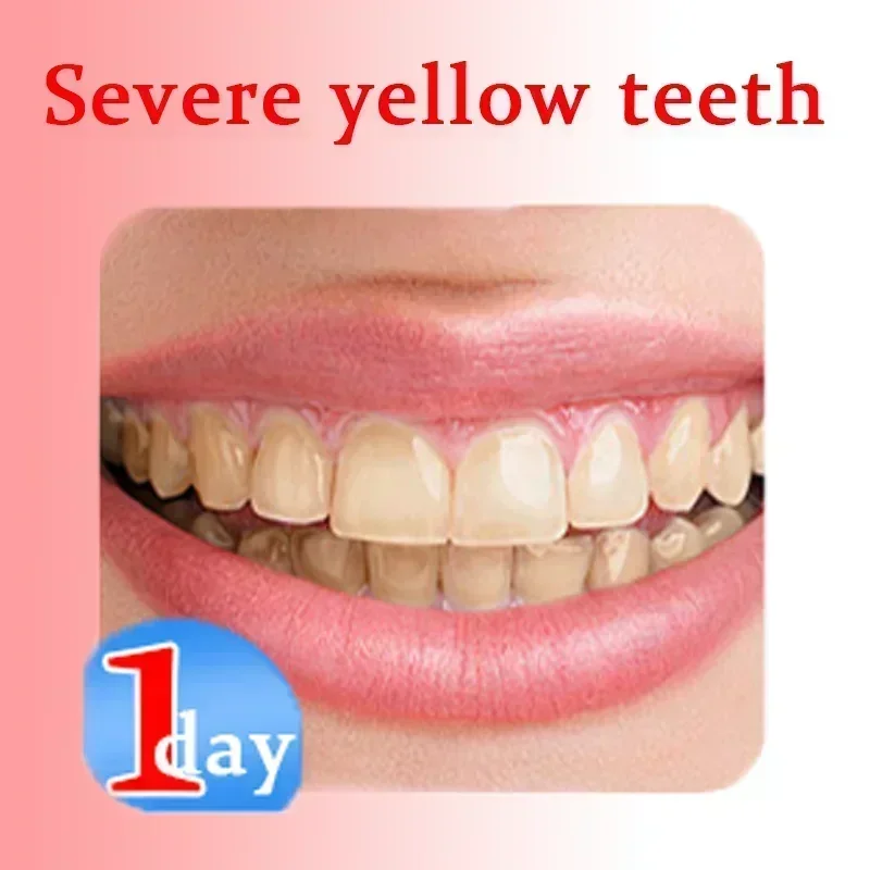 Whitening Toothpaste Cleans Cavities Repairs All Cavities Reduces Smoke Stains And Yellow Cavities Protects Teeth