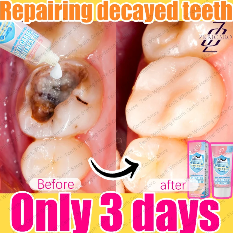 2025 Latest Teeth Cleaning to Eliminate Tooth Decay