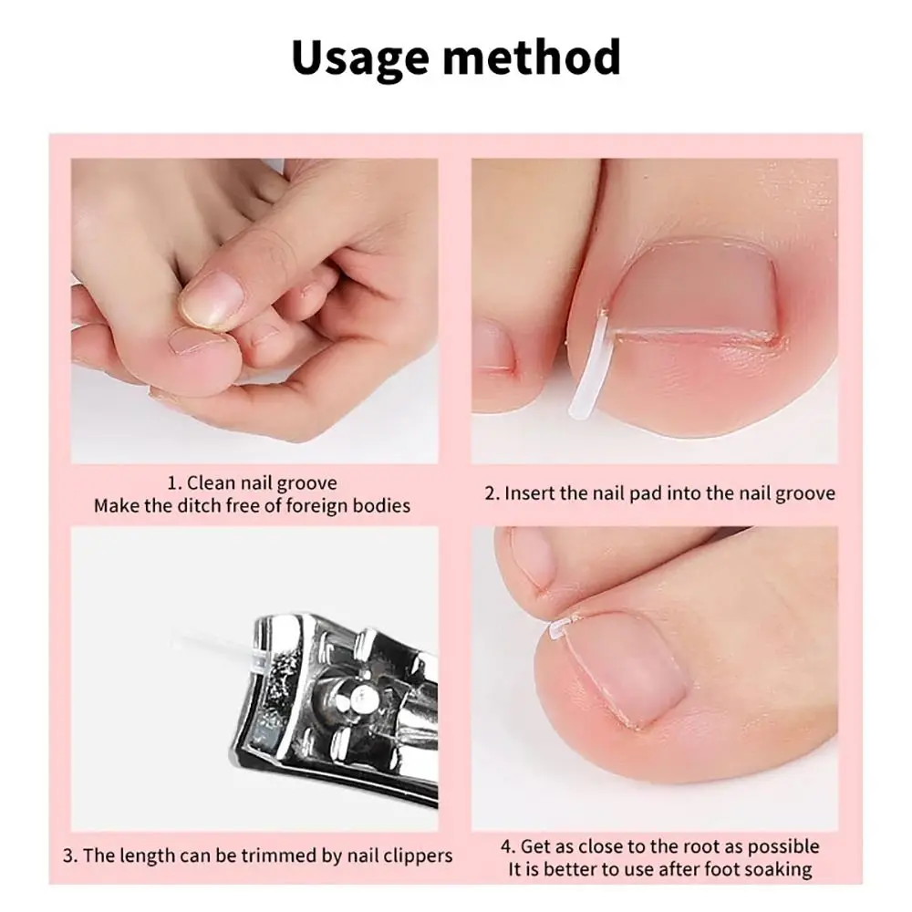 50Pcs/box Brace Pedicure Tool Ingrown Toenail Correction Tool Filling Pad Nail Picker Elastic Patch Sticker Plastic