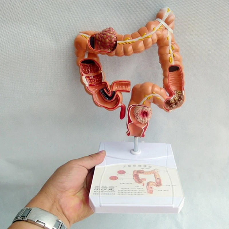 Teaching Model,Human Large Intestine Anatomy Model Visceral Lesion Model Human Digestive System Learning Model