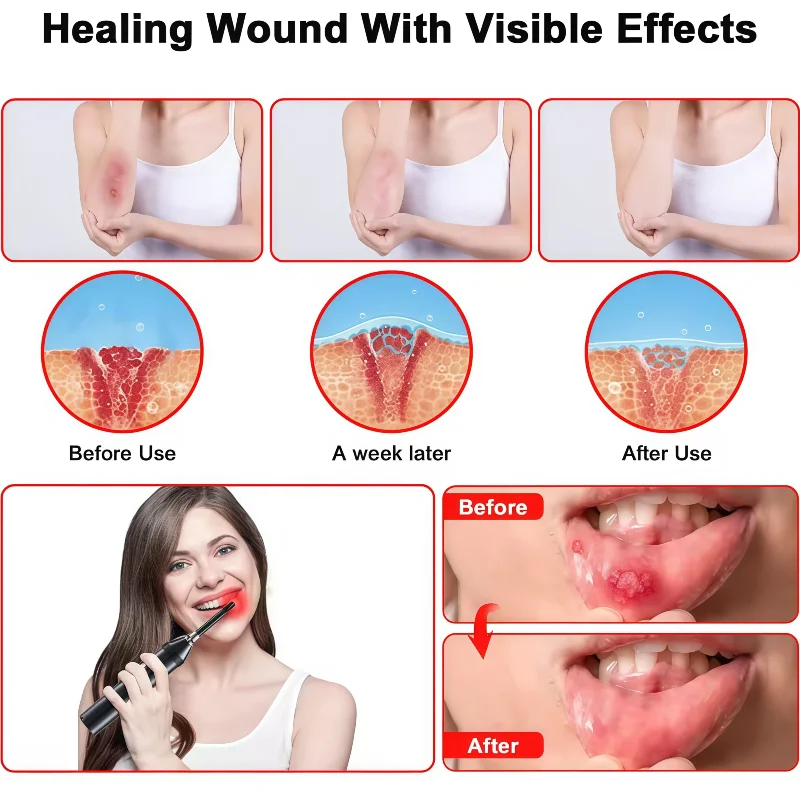 

Red Light Therapy Device Cold Sore Canker Sore Treatment Infrared Light Therapy Wand for Mouth Nose Ear Knee Feet Hands Ankle