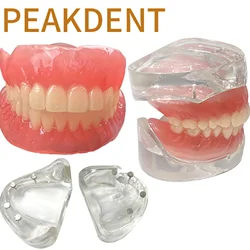 Clear Dental Overdenture Inferior Model - Locator Denture Model Removable Bridge 4 Implants Restoration Teaching Study