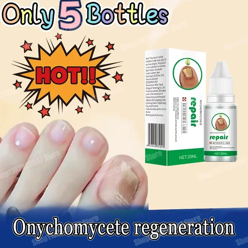 

Fungal Nail Treatment Feet Care Essence Nail Foot Whitening Toe Nail Fungus Removal Gel Anti Infection Paronychia Onychomycosis