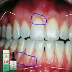 Rapidamente le gocce di siero per la riparazione delle gengive rimuovono i denti siero per le macchie alleviare il gonfiore gengivale sbiancare la gomma igiene parodontale igiene orale