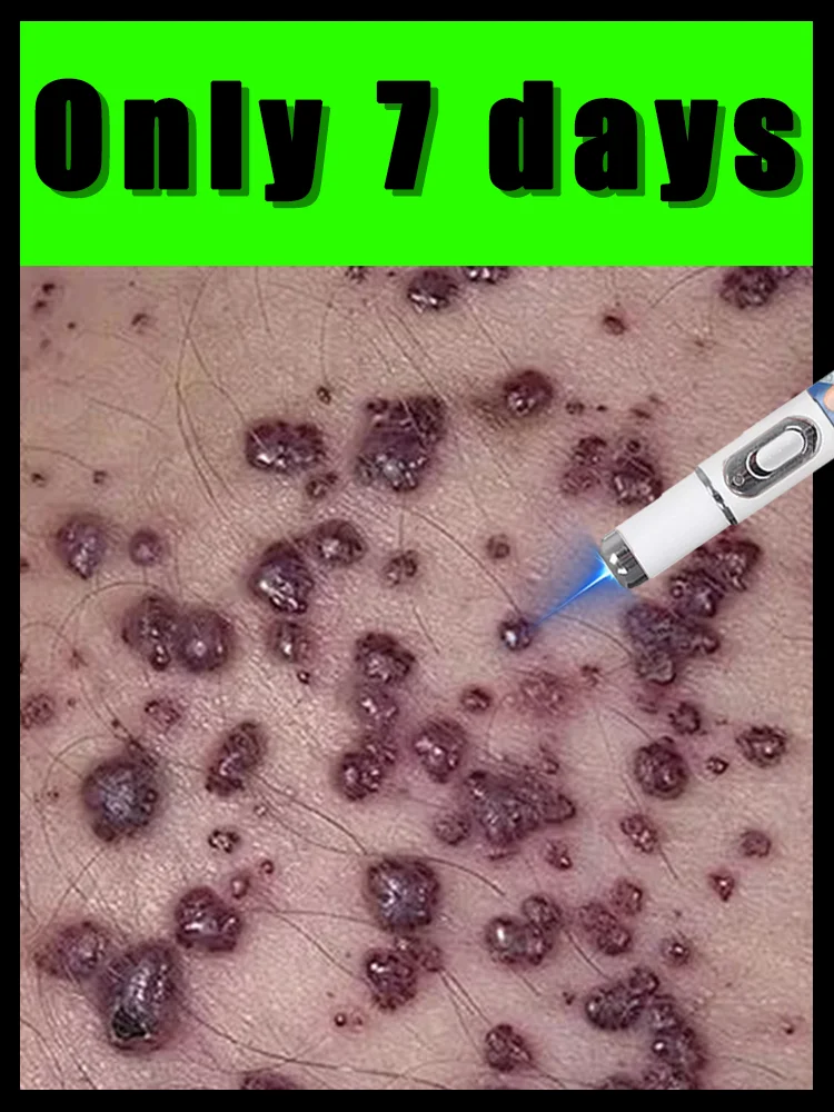 

Latest upgraded 2nd generation blue light pen solve warts,home use,2025 hotsale wart care tools,free shipping