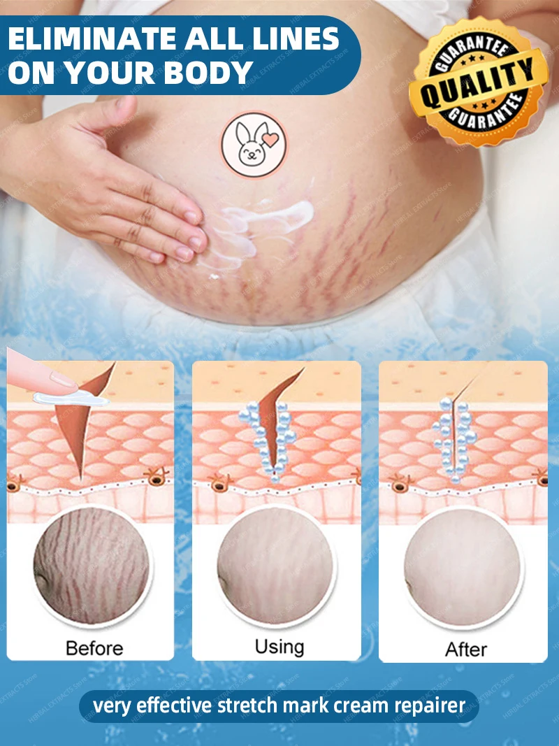 Remove Stretch Marks