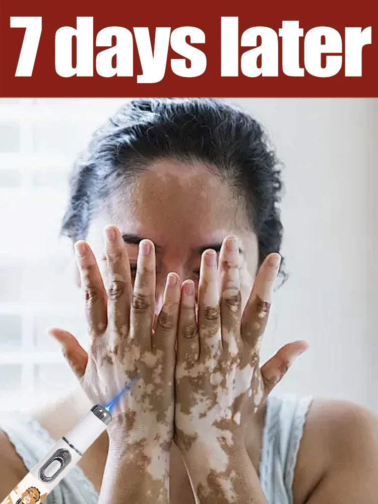 Generation-TWOND Laser Says Goodbye To Vitiligo In 7 Days