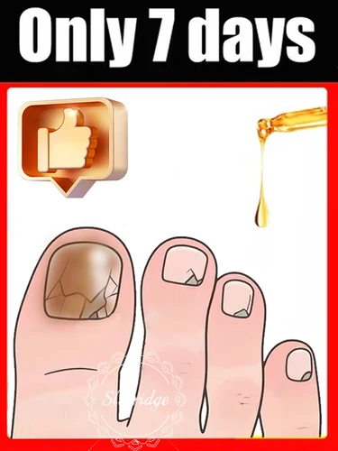 Parche para hongos en las uñas de los pies, parches impermeables para reparación de uñas, pegatina de corrección encarnada, herramienta para el cuidado de los pies descoloreados y dañados, 2025