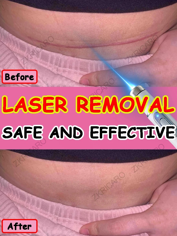 

Нет макияжа, как шрам, лазер медицинского класса может регенерировать свою кожу!