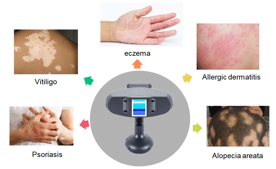 Medical Grade EXCL Lamp Skin Analyzer Vitiligo Mini 308nm Psoriasis Laser Excimer For Vitiligo Psoriasis Treatment