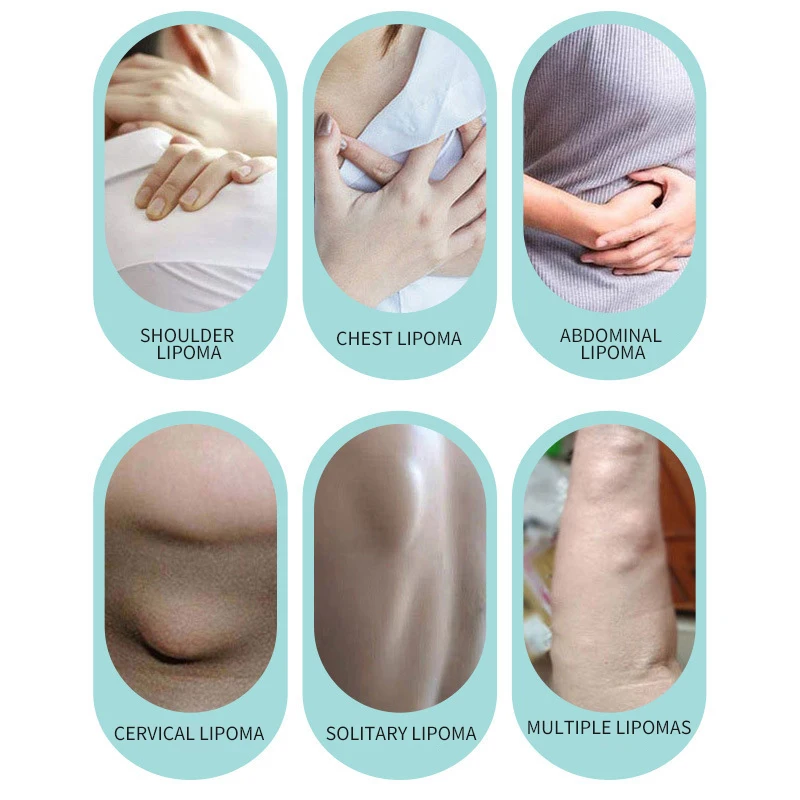 ครีมสุขภาพไขมัน 30g Lipoma ไขมัน Nodules ผิว Hard Blocks ใช้ครีมสารสกัดจากสมุนไพรฮอร์โมนธรรมชาติฟรี